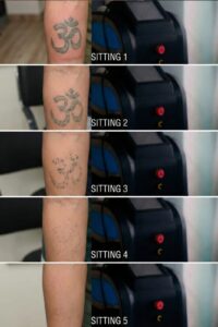 tattoo removal raipur