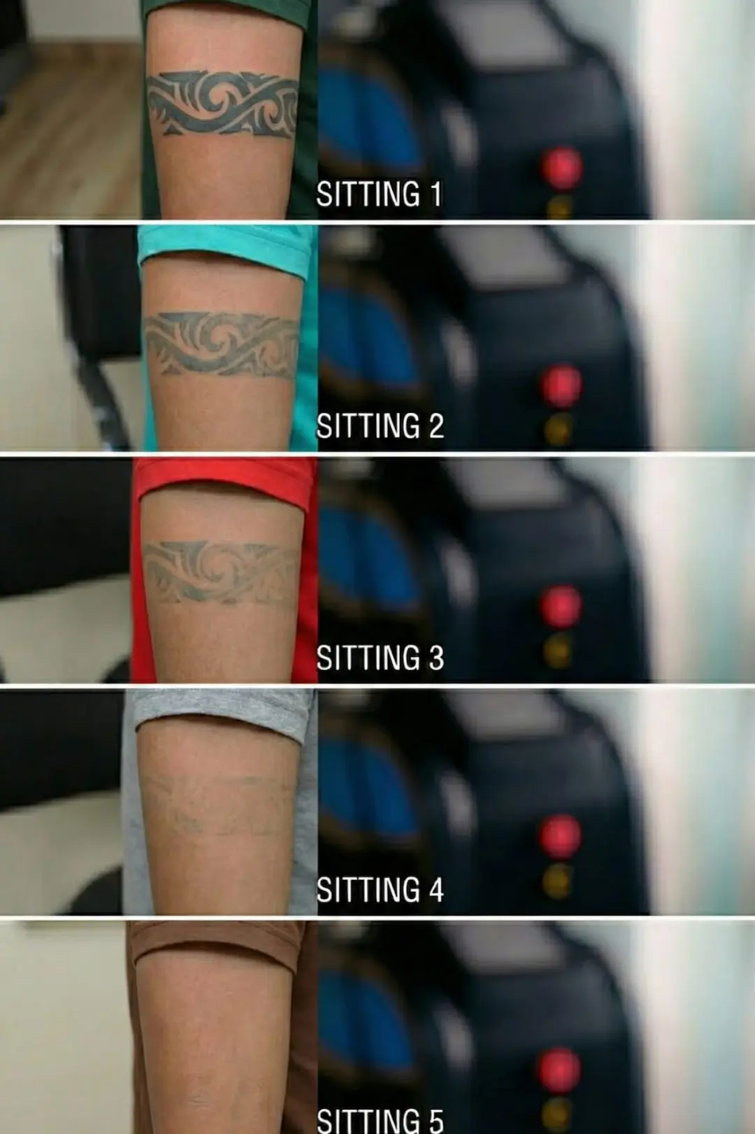 Laser tattoo removal using Pico laser in Raipur