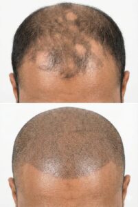 Offering Hair micropigmentation before and after result male scalp tattoo treatment Raipur